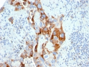 IHC staining of FFPE human colon carcinoma with TMEPAI antibody (clone PMEPA1/2696). HIER: boil tissue sections in pH6, 10mM citrate buffer, for 10-20 min and allow to cool before testing.