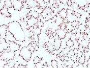 IHC staining of FFPE human thyroid carcinoma with Cyclin D1 antibody (clone CCND1/2593). HIER: boil tissue sections in pH6, 10mM citrate buffer, for 10-20 min and allow to cool before testing.