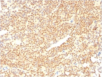 IHC staining of FFPE human mantle cell carcinoma with Cyclin D1 antibody (clone CCND1/2593). HIER: boil tissue sections in pH6, 10mM citrate buffer, for 10-20 min and allow to cool before testing.~