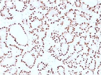 IHC staining of FFPE human thyroid carc