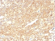 IHC staining of FFPE human mantle cell carcinoma with Cyclin D1 antibody (clone CCND1/2593). HIER: boil tissue sections in pH6, 10mM citrate buffer, for 10-20 min and allow to cool before testing.