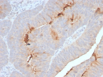 IHC staining of FFPE human colon carcinoma with recombinant SAA antibody. HIER: boil tissue sections in 10mM Tris with 1mM EDTA, pH 9, for 10-20 min and allow to cool before testing.~