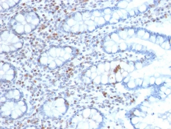 IHC testing of FFPE human colon carcinoma with BMI1 antibody (clone BMI1/2689). HIER: boil tissue sections in pH 9 10mM Tris with 1mM EDTA for 10-20 min followed by cooling at RT for 20 min.~