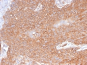 IHC testing of FFPE human pancreatic cancer with recombinant Spectrin beta III antibody (clone SPTBN2/2894R). Required HIER: boil tissue sections in pH 9 10mM Tris with 1mM EDTA for 10-20 min followed by cooling at RT for 20 min.