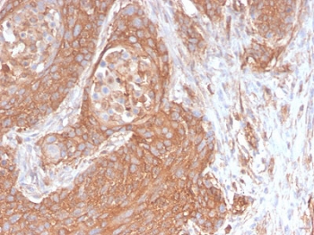IHC testing of FFPE human pancreatic cancer with recombinant Spectrin beta III antibody (clone SPTBN2/2894R). Required HIER: boil tissue sections in pH 9 10mM Tris with 1mM EDTA for 10-20 min followed by cooling at RT for 20 min.~