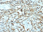 IHC staining of FFPE human breast carcinoma with pS2 antibody (clone TFF1/2133). HIER: boil tissue sections in pH 9 10mM Tris with 1mM EDTA for 20 min and allow to cool before testing.