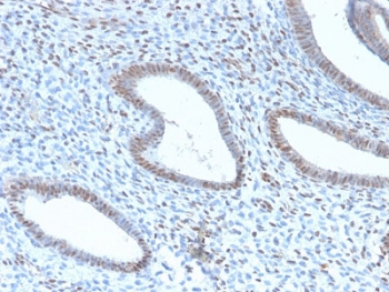 IHC testing of FFPE human endometrial carcinoma with recombinant TLE1 antibody (clone TLE1/2946R). Required HIER: boil tissue sections in pH 9 10mM Tris with 1mM EDTA for 10-20 min and allow to cool before testing.~