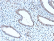 IHC testing of FFPE human endometrial carcinoma with recombinant TLE1 antibody (clone TLE1/2946R). Required HIER: boil tissue sections in pH 9 10mM Tris with 1mM EDTA for 10-20 min and allow to cool before testing.