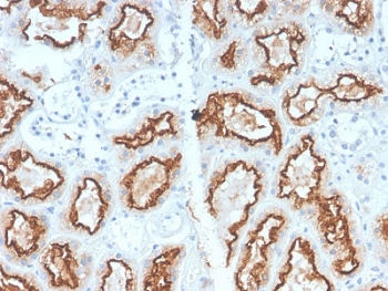 IHC staining of FFPE human renal cell carcinoma with recombinant Carbonic Anhydrase 9 antibody (clone CA9/2993R). HIER: boil tissue sections in pH6, 10mM citrate buffer, for 10-20 min and allow to cool before testing.~