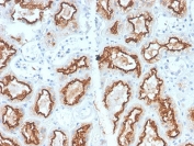 IHC staining of FFPE human renal cell carcinoma with recombinant Carbonic Anhydrase 9 antibody (clone CA9/2993R). HIER: boil tissue sections in pH6, 10mM citrate buffer, for 10-20 min and allow to cool before testing.