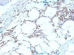 IHC testing of FFPE human mesothelioma with Calretinin antibody (clone CALB2/2603). HIER: boil tissue sections in pH 9 10mM Tris with 1mM EDTA for 10-20 min followed by cooling at RT for 20 min.~
