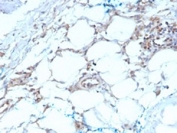 IHC testing of FFPE human mesothelioma with Calretinin antibody (clone CALB2/2603). HIER: boil tissue sections in pH 9 10mM Tris with 1mM EDTA for 10-20 min followed by cooling at RT for 20 min.