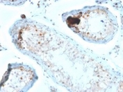 IHC testing of FFPE human testicular carcinoma with Calbindin 2 antibody (clone CALB2/2685). HIER: boil tissue sections in pH 9 10mM Tris with 1mM EDTA for 10-20 min followed by cooling at RT for 20 min.