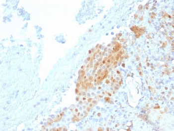 IHC testing of FFPE human Mesothelioma with Calbindin 2 antibody (clone CALB2/2685). HIER: boil tissue sections in pH 9 10mM Tris with 1mM EDTA for 10-20 min followed by cooling at RT for 20 min.~
