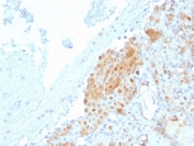 IHC testing of FFPE human Mesothelioma with Calbindin 2 antibody (clone CALB2/2685). HIER: boil tissue sections in pH 9 10mM Tris with 1mM EDTA for 10-20 min followed by cooling at RT for 20 min.