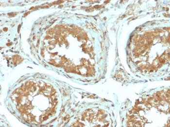 IHC testing of FFPE human testicular carcinoma with recombinant B7-H4 antibody (clone B7H4/2652R). HIER: boil tissue sections in pH6, 10mM citrate buffer, for 10-20 min followed by cooling at RT for 20 min.~