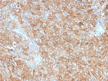 IHC staining of FFPE human prostate carcinoma with recombinant CD63 antibody (clone LAMP3/2990R). HIER: boil tissue sections in 10mM Tris with 1mM EDTA, pH 9 for 10-20 min followed by cooling.~
