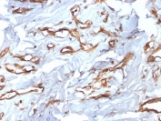 IHC testing of FFPE human angiosarcoma with recombinant CD34 antibody (clone HPCA1/2598R). Required HIER: boil tissue sections in 10mM Tris with 1mM EDTA, pH 9, for 10-20 min followed by cooling at RT for 20 min.
