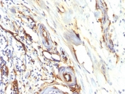 IHC testing of FFPE human colon carcinoma with recombinant CD34 antibody (clone HPCA1/2598R). Required HIER: boil tissue sections in 10mM Tris with 1mM EDTA, pH 9, for 10-20 min followed by cooling at RT for 20 min.