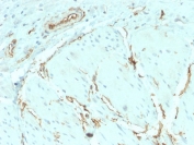 IHC testing of FFPE human breast carcinoma with recombinant CD34 antibody (clone HPCA1/2598R). Required HIER: boil tissue sections in 10mM Tris with 1mM EDTA, pH 9, for 10-20 min followed by cooling at RT for 20 min.