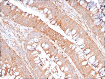 IHC staining of FFPE human colon carinoma with recombinant CD59 antibody (clone MACIF/2867R) . HIER: boil tissue sections in pH6, 10mM citrate buffer, for 10-20 min followed by cooling at RT for 20 min.~
