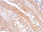 IHC staining of FFPE human colon carinoma with recombinant CD59 antibody (clone MACIF/2867R) . HIER: boil tissue sections in pH6, 10mM citrate buffer, for 10-20 min followed by cooling at RT for 20 min.