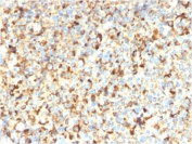 IHC staining of FFPE human melanoma with recombinant CD63 antibody (clone rMX-49.129.5). HIER: boil tissue sections in pH6, 10mM citrate buffer, for 10-20 min followed by cooling at RT for 20 min.