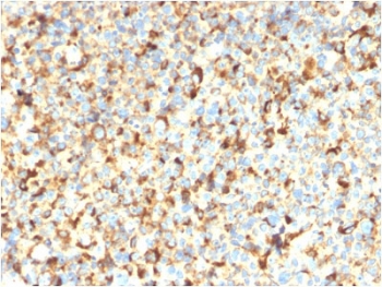 IHC staining of FFPE human melanoma with recombinant CD63 antibody (clone rMX-49.129.5). HIER: boil tissue sections in pH6, 10mM citrate buffer, for 10-20 min followed by cooling at RT for 20 min.~