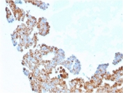 IHC staining of FFPE human breast carcinoma with CDC34 antibody (clone CPTC-CDC34-2). HIER: boil tissue sections in pH6, 10mM citrate buffer, for 10-20 min followed by cooling at RT for 20 min.