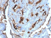 IHC staining of FFPE human breast carcinoma with CDC34 antibody (clone CPTC-CDC34-2). HIER: boil tissue sections in pH6, 10mM citrate buffer, for 10-20 min followed by cooling at RT for 20 min.