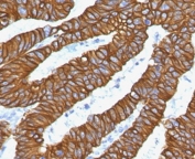 IHC staining of FFPE human colon carinoma with recombinant Keratin 18 antibody (clone CTKN18-2R). Required HIER: boil tissue sections in 10mM citrate buffer, pH 6, for 10-20 min and allow to cool before testing.