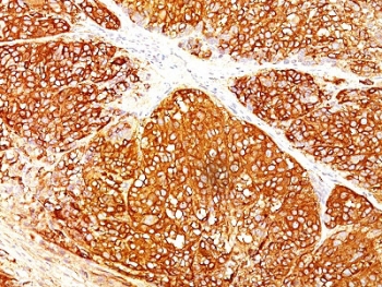IHC staining of FFPE human melanoma with Melanoma Marker antibody cocktail (A103 + T311 + HMB45). HIER: boil tissue sections in pH 9 10mM Tris with 1mM EDTA for 10-20 min and allow to cool before testing.~