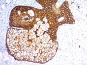 IHC staining of FFPE human skin with recombinant Pan Cytokeratin antibody (clones KRTL/1577R + KRTH/1576R). HIER: boil tissue sections in pH6, 10mM citrate buffer, for 10-20 min and allow to cool before testing.