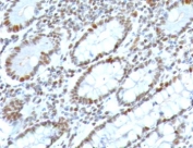 IHC testing of FFPE human colon carcinoma with BMI1 antibody (clone PGRF4-1). HIER: boil tissue sections in pH 9 10mM Tris with 1mM EDTA for 10-20 min followed by cooling at RT for 20 min.