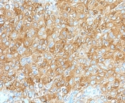 IHC staining of FFPE human prostate carcinoma with recombinant CD63 antibody (clone CDLA63-2R). HIER: boil tissue sections in 10mM Tris with 1mM EDTA, pH 9 for 10-20 min followed by cooling.