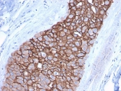 IHC staining of FFPE human breast carcinoma with HER2 antibody (clone ERBB2/3092). HIER: boil tissue sections in pH6, 10mM citrate buffer, for 10-20 min followed by cooling at RT for 20 min.