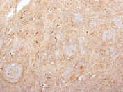 IHC staining of FFPE human prostate carcinoma with Fibronectin antibody (clone 616). HIER: boil tissue sections in 10mM Tris with 1mM EDTA, pH 9, for 10-20 min followed by cooling prior to testing.