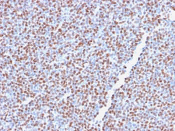 IHC testing of FFPE anaplastic large-cell lymphoma with recombinant ALK antibody (clone ALK1/2766R). HIER: boil tissue sections in 10mM Tris buffer with 1mM EDTA, pH 9, for 10-20 min followed by cooling at RT for 20 min.~