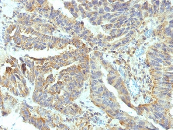 IHC testing of FFPE human ovarian carcinoma with ALPL antibody (clone V17.1). Required HIER: boil tissue sections in 10mM Tris with 1mM EDTA, pH 9, for 10-20 min followed by cooling at RT for 20 min.~