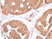 IHC testing of FFPE human prostate carcinoma stained with GLO1 antibody. Required HIER: boiling tissue sections in pH 9 10mM Tris with 1mM EDTA for 10-20 min followed by cooling at RT for 20 min.