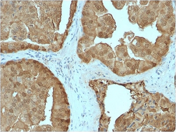 IHC testing of FFPE human prostate carcinoma stained with GLO1 antibody. Required HIER: boiling tissue sections in pH 9 10mM Tris with 1mM EDTA for 10-20 min followed by cooling at RT for 20 min.~