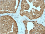 IHC testing of FFPE human prostate carcinoma stained with GLO1 antibody. Required HIER: boiling tissue sections in pH 9 10mM Tris with 1mM EDTA for 10-20 min followed by cooling at RT for 20 min.