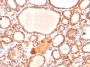 IHC testing of FFPE human thyroid carcinoma stained with GLO1 antibody. Required HIER: boiling tissue sections in pH 9 10mM Tris with 1mM EDTA for 10-20 min followed by cooling at RT for 20 min.
