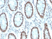 IHC staining of FFPE human colon carcinoma with MSH6 antibody (clone MSH6/3085). HIER: boil tissue sections in pH 9 10mM Tris with 1mM EDTA for 10-20 min and allow to cool before testing.