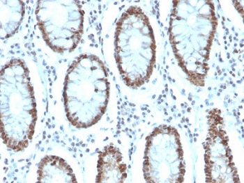 IHC staining of FFPE human colon carcinoma with MSH6 antibody. HIER: boil tissue sections in pH 9 10mM Tris with 1mM EDTA for 10-20 min and allow to cool before testing.