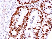 IHC staining of FFPE human colon carcinoma with MSH6 antibody (clone MSH6/3085). HIER: boil tissue sections in pH 9 10mM Tris with 1mM EDTA for 10-20 min and allow to cool before testing.