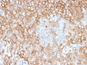 IHC staining of FFPE human lung cancer with HLA-DR antibody (clone TAL 1B5). HIER: boil tissue sections in pH6, 10mM citrate buffer, for 10-20 min and allow to cool before testing.