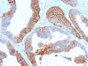 IHC staining of FFPE human prostate cancer with HLA-DR antibody (clone TAL 1B5). HIER: boil tissue sections in pH6, 10mM citrate buffer, for 10-20 min and allow to cool before testing.