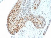 IHC testing of FFPE human cervical tumor with phospho-c-Jun antibody (clone C-J 4C4/1). HIER: boil tissue sections in pH6, 10mM citrate buffer, for 10-20 min followed by cooling at RT for 20 min.