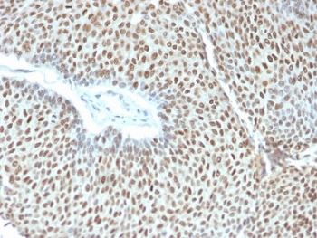 IHC testing of FFPE human cervical tumor with phospho-c-Jun antibody (clone C-J 4C4/1). HIER: boil tissue sections in pH6, 10mM citrate buffer, for 10-20 min followed by cooling at RT for 20 min.~